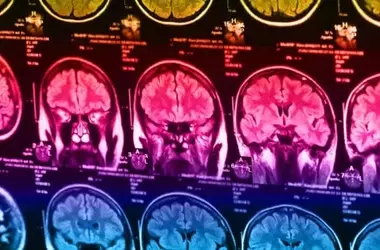 Youth BMI Linked to Altered Brain Connectivity