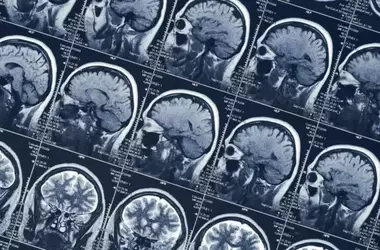 Shift Work Linked to Brain Volume Reduction and Cognitive Decline