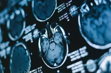Sleep Quality Interacts with Genetics to Impact Alzheimer's Risk