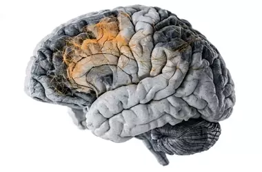 Schizophrenia's Synaptic Origins Uncovered by Advanced Brain Imaging