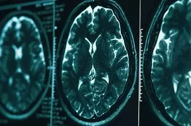 Brain Structure Predicts Antidepressant Response