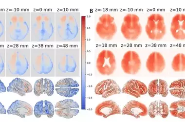 AI Reveals Asymmetric Brain Aging and Alzheimer's Markers