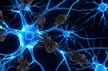 Brain Scans Uncover Tau Buildup in Late-Onset Psychosis Patients